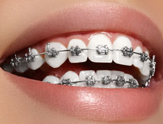 歯並びを治す方法はやはり矯正治療が一番健康的