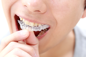 歯並びを整える方法