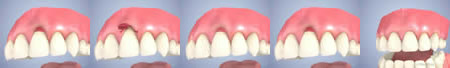 再生療法、審美歯周外科治療のイメージ