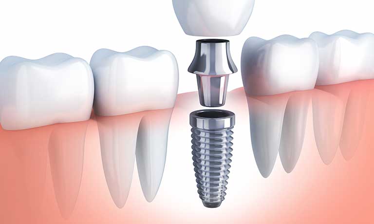 人工歯根：インプラント治療のイメージ