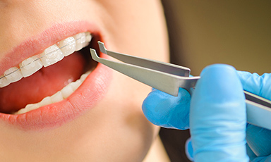 矯正歯科治療のイメージ