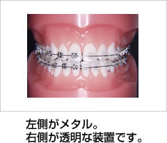 メタルの装置