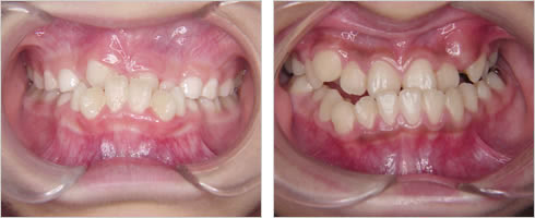 下顎前突、反対咬合の症例
