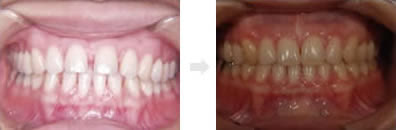 空隙歯列の症例