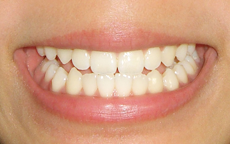 正常な歯並び