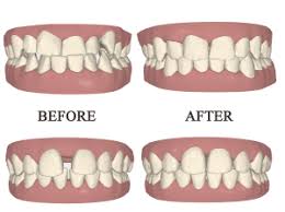 治療後の歯並びのシミュレーション