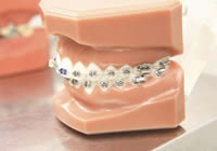 歯を抜かずに歯列矯正できる方法も増加傾向に