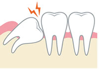 埋まった歯を矯正する牽引の施術内容と治療期間の目安
