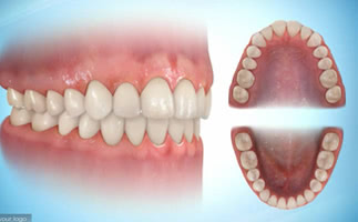 治療後の歯並び