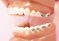 歯ぐきのかゆみは矯正装置による金属アレルギー？考えられる症状の主な原因