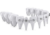 歯科矯正で用いられる材料紹介  チューブ破損の際の対処法