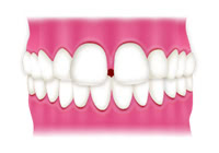 すきっ歯を埋める治療法には歯列矯正が最適