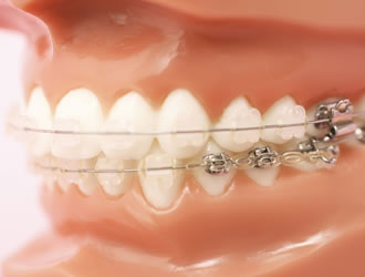 歯列矯正が適している理由について