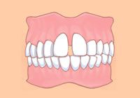 すきっぱ」「空隙歯列」とは、その原因・特徴・治療法について | 矯正歯科スマイルコンセプト